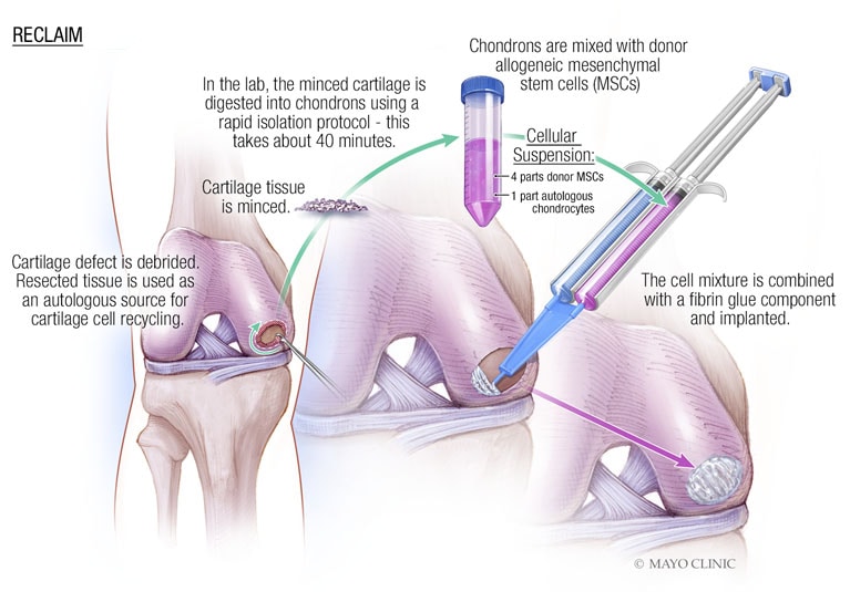 Mayo Clinic Explores Stem Cell Therapy for Knee Arthritis Treatment