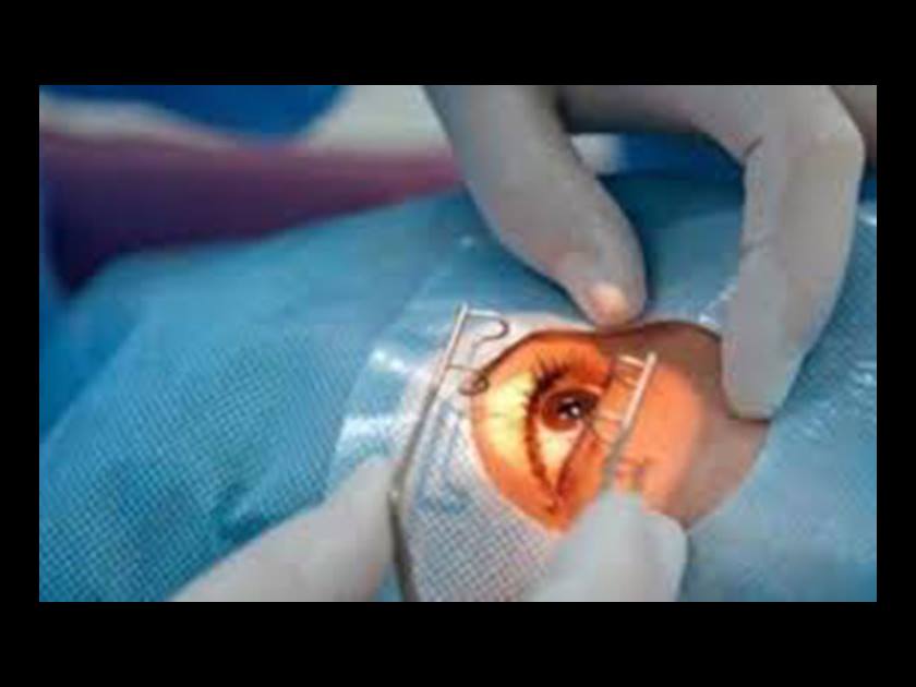 Stem Cell Cure for Blindness: A Pioneering Attempt by Surgeons in London