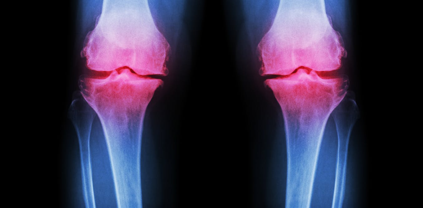 The Truth About Stem Cell Therapy For Arthritis