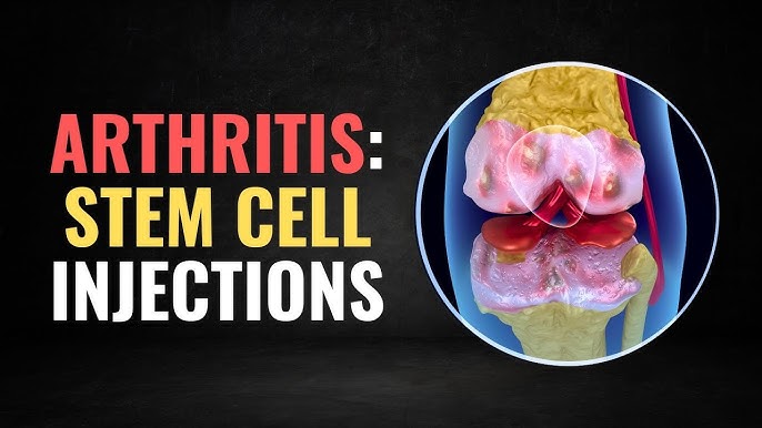 The Truth About Stem Cell Therapy For Arthritis